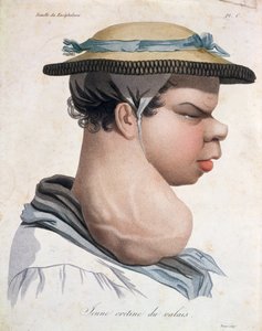 Young Cretin fra Valais, illustrasjon fra en bok av Baron Jean Louis Alibert (1768-1837)